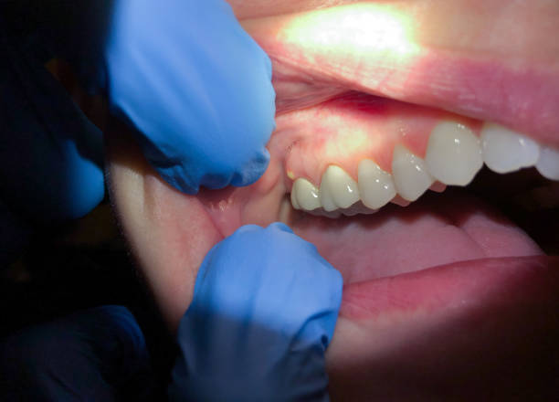 Best Dentist for Tooth Abscess  in Cannon Af, NM